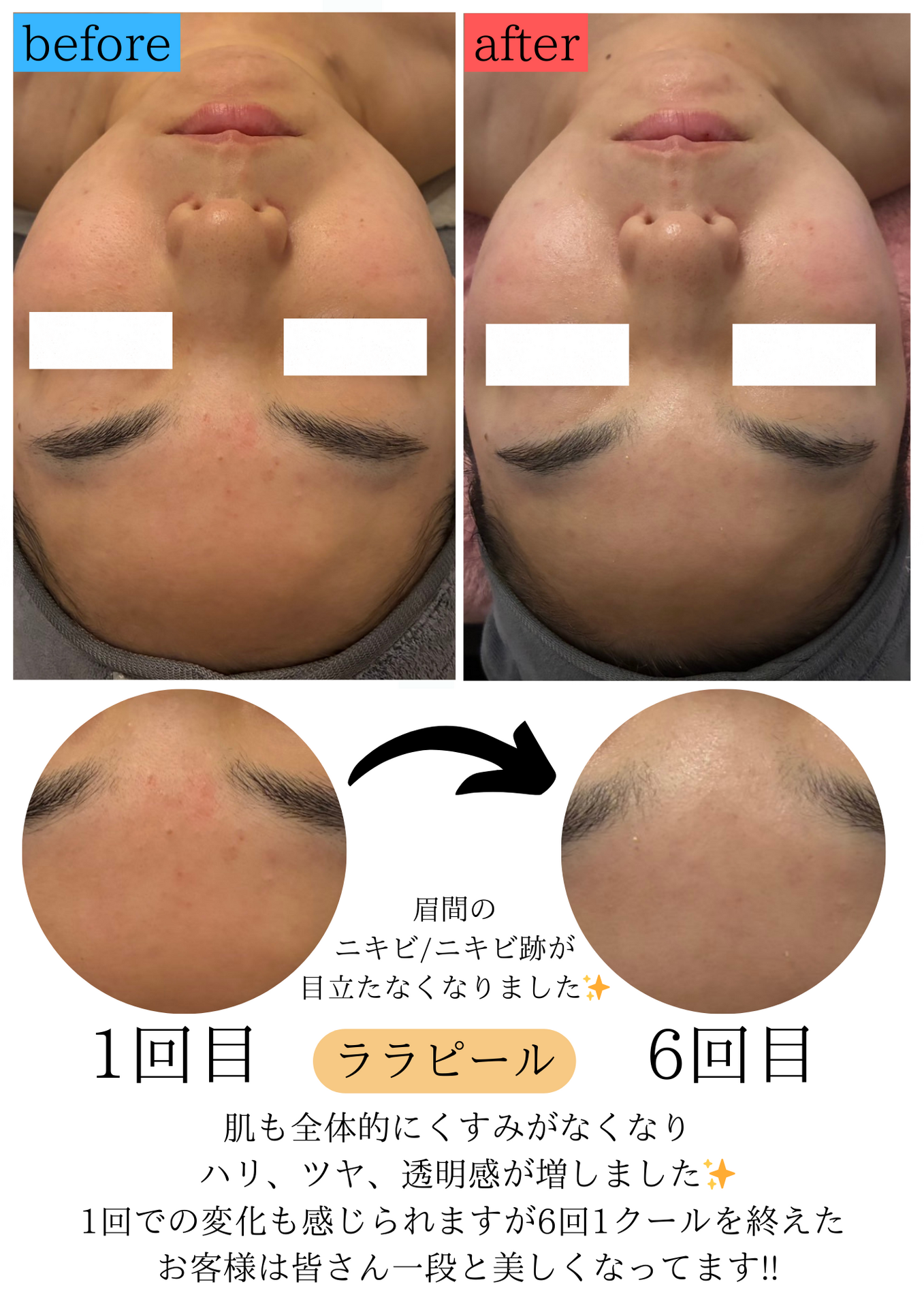 【話題のララピール☆6回1クールの意味とお客様の声♪】