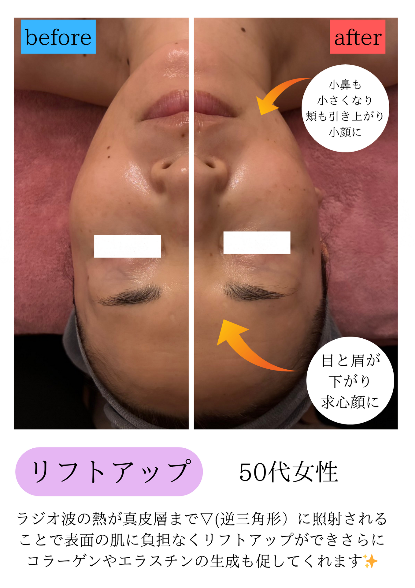 知らないと損！リフトアップの真実🤫