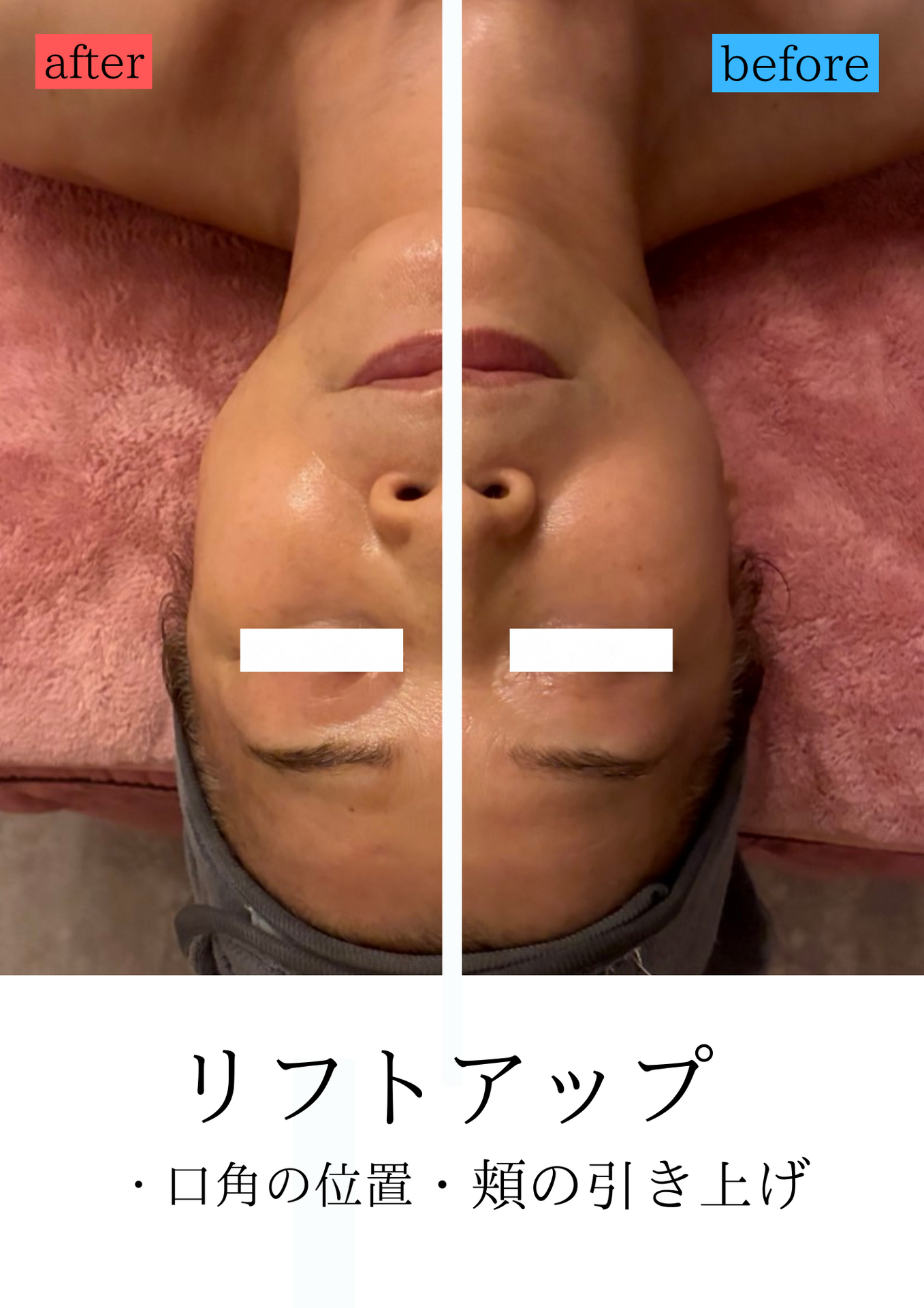切らないリフトアップで若見えフェイス✨