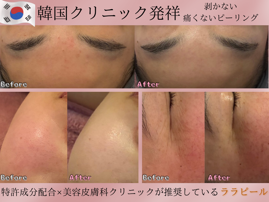 【エイジングケアの新常識】ララピールで内側からシワ改善！✨