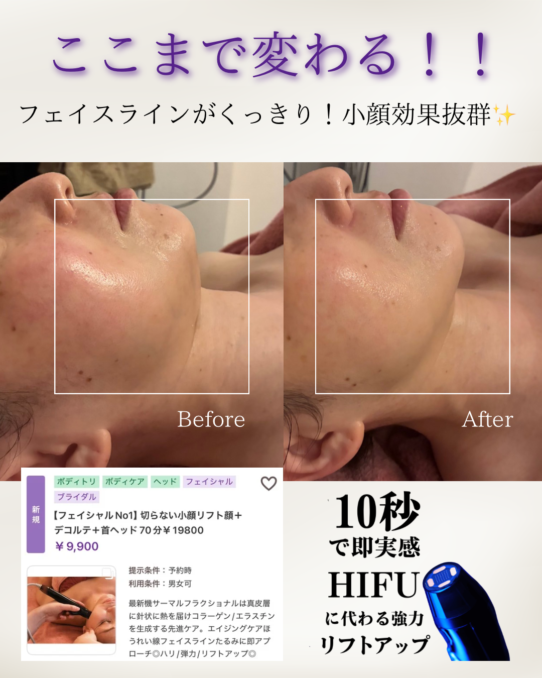 ここまで変わる！切らない小顔リフトアップ✨