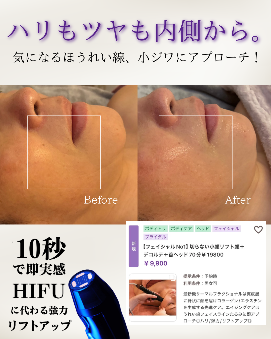 ✨サーマルフラクショナルでほうれい線にアプローチ?‍♀️✨ | ブログ 
