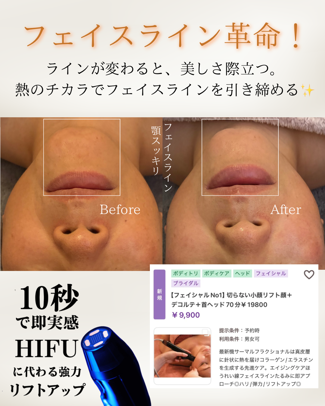 💎フェイスライン革命✨サーマルフラクショナルで強力リフトアップ
