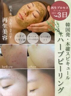 🌿茨城県初上陸！韓国式ハーブピーリング新登場✨