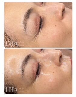✨ララピールでシワケア🌿年齢肌にやさしい最新ピーリング
