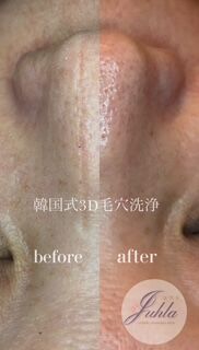 ✨大好評！韓国式3D毛穴洗浄でつるんと美肌へ🫧