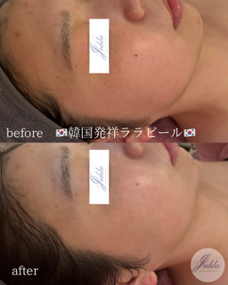 ララピールと従来のピーリングの違い？